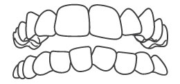 Crowded-teeth - Invisible braces treatment